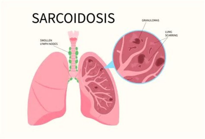 Can you drink alcohol if you have sarcoidosis?