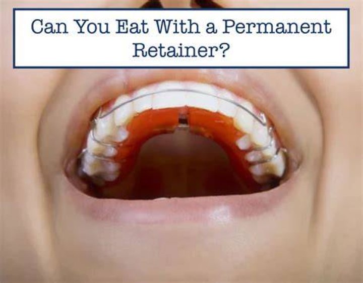 Can you eat with metal retainers?