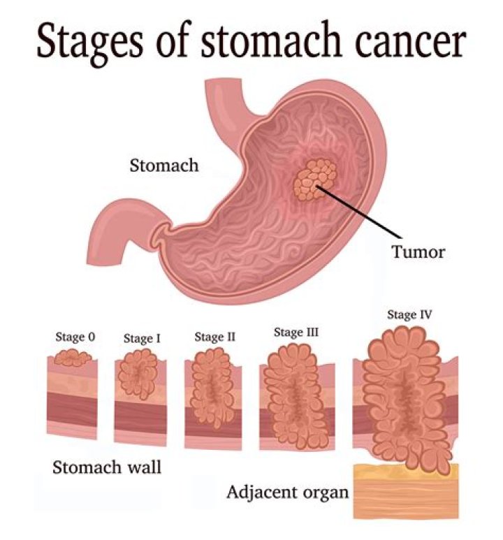Can you feel a stomach tumor from the outside?