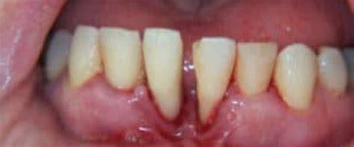 Can you fix severe periodontal disease?