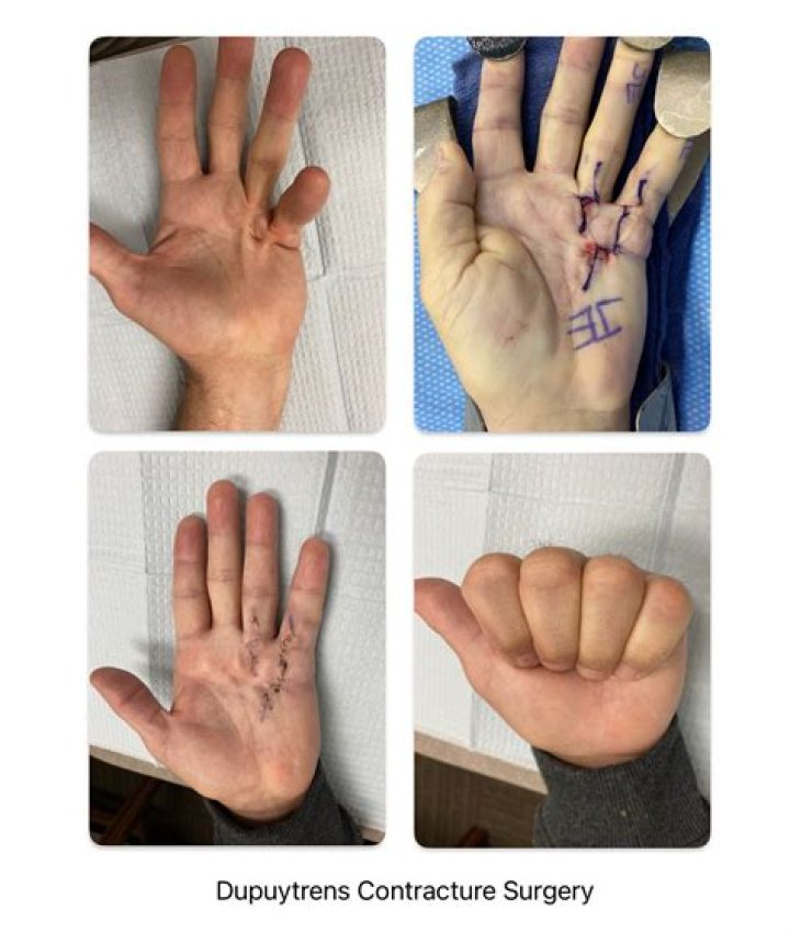 Can you have Dupuytren's without contracture?