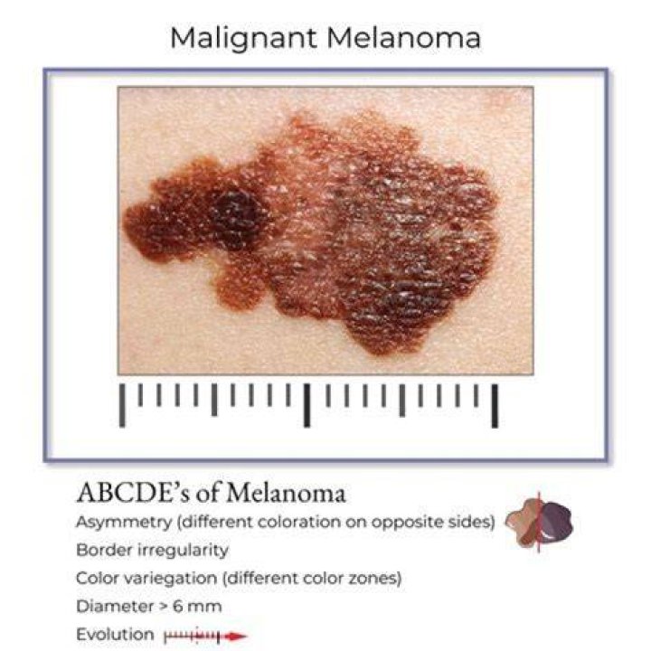 Can you have melanoma for years and not know?