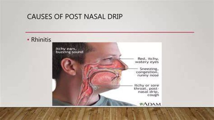Can you have post nasal drip without a runny nose?