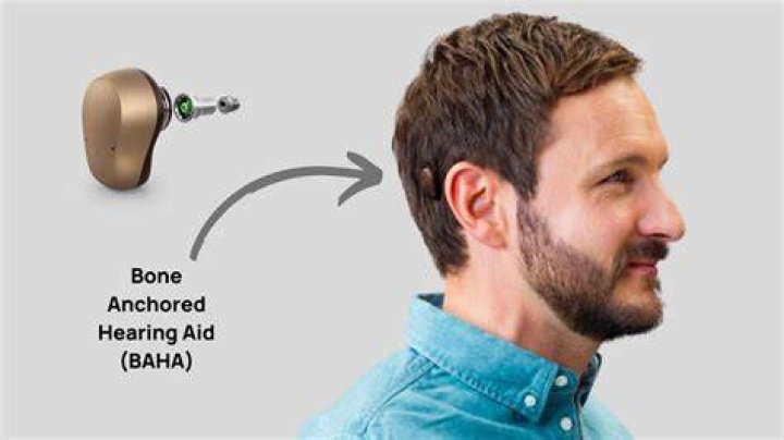 Can you hear normally with a cochlear implant?
