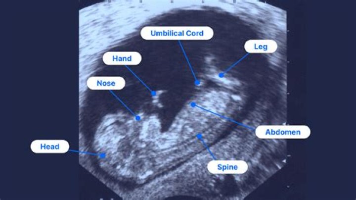 Can you opt out of ultrasounds?