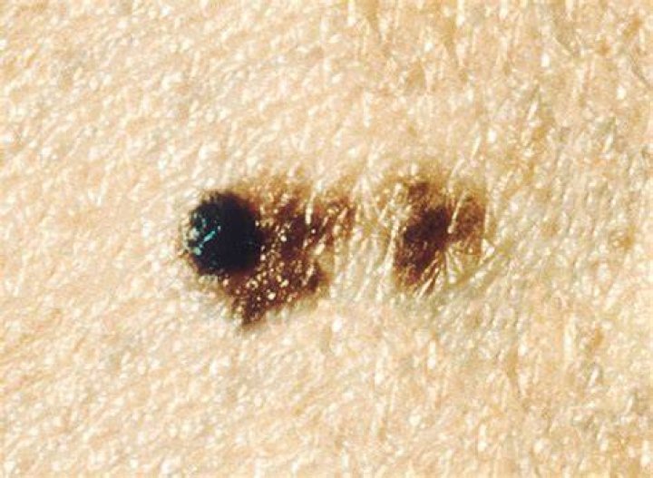 Can you pick off melanoma?