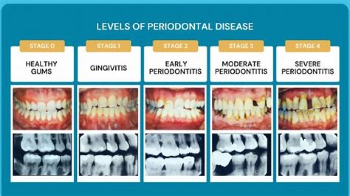 Can you stop slight periodontal disease?