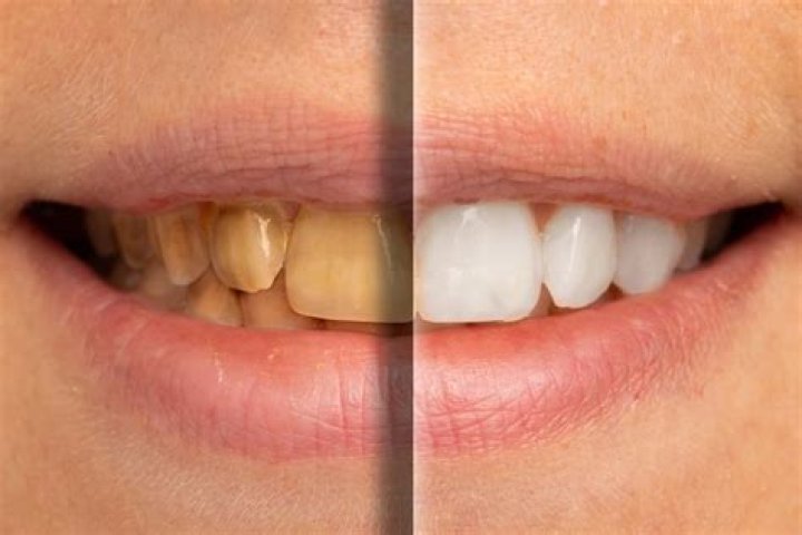 Can you turn yellow teeth back to white?