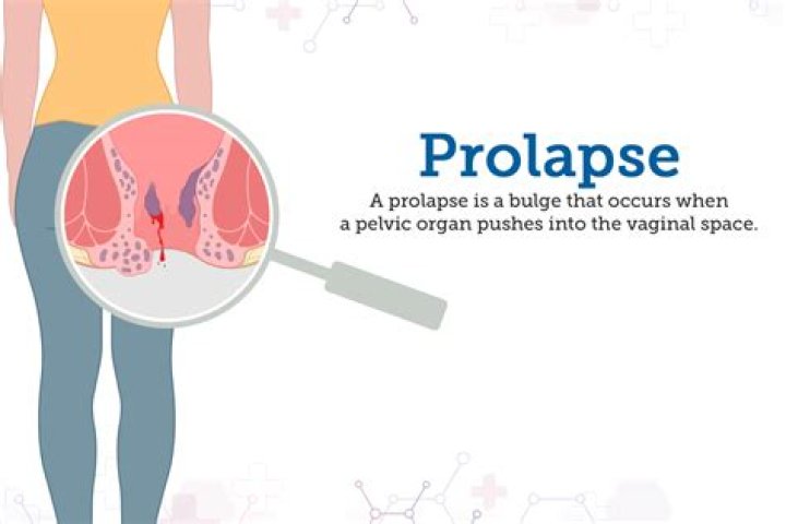 Can you use a tampon if you have a prolapse?