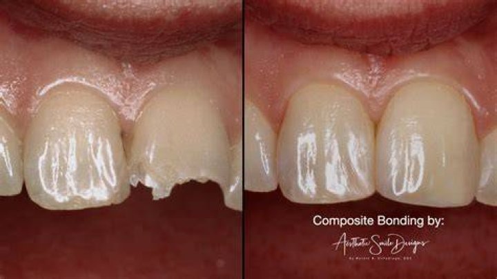 Can you use ZOE with composite?