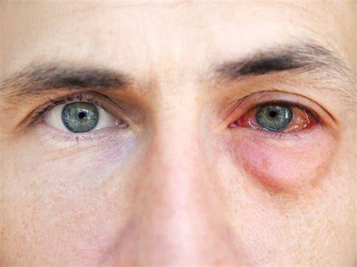 Can your eye fall out?