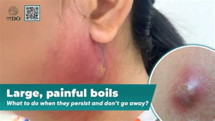 Can your period cause boils?