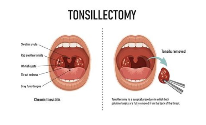 Can your tonsils burst?