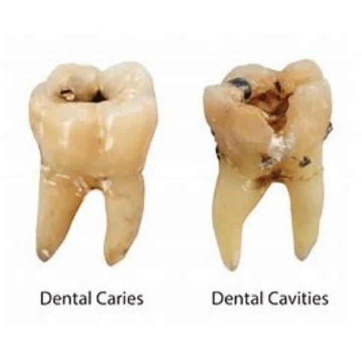Do all cavities have to be drilled?