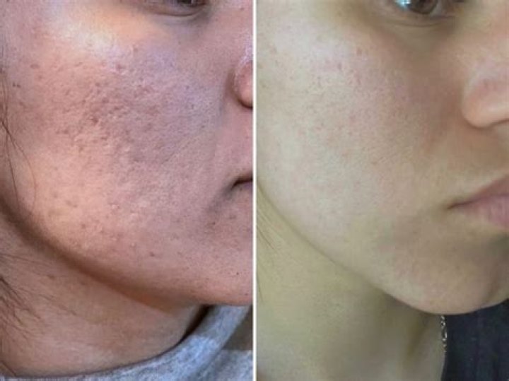 Do apples help with acne?
