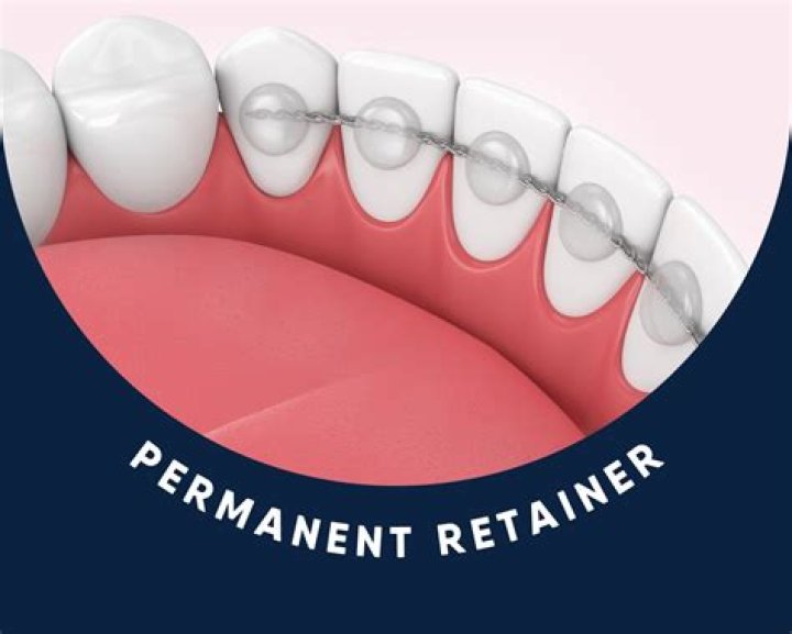 Do clear retainers work better than metal?