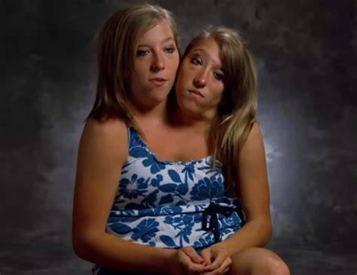 Do conjoined twins share a stomach?