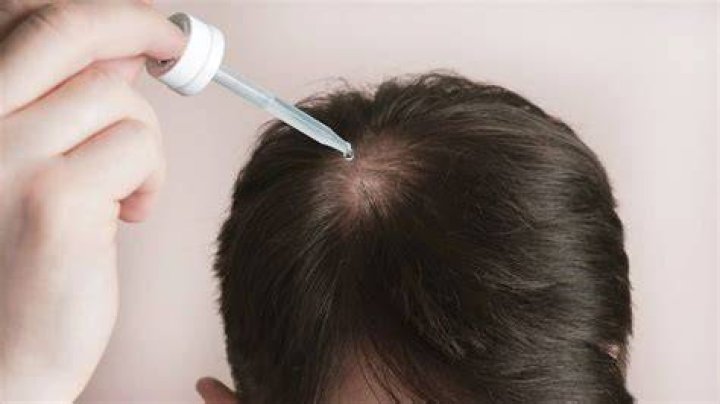 Do cortisone shots cause hair loss?