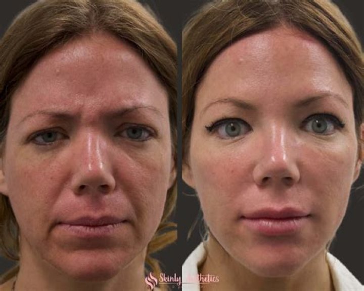 Do fillers permanently stretch skin?