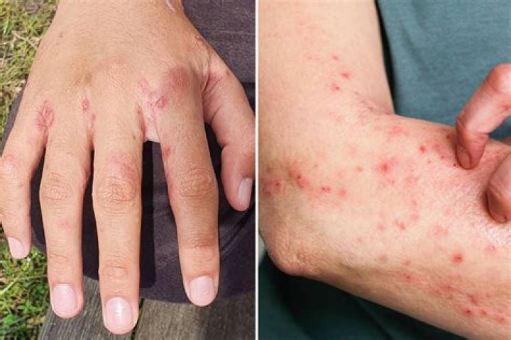 Do I have scabies or eczema?