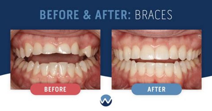 Do I have to brush after every meal with braces?