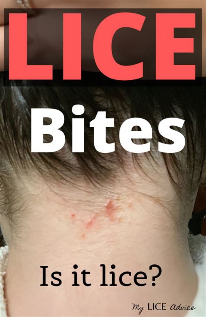 Do lice bite your neck?