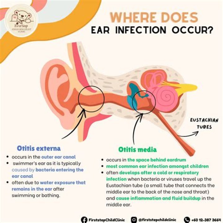 Do pacifiers cause ear infections?