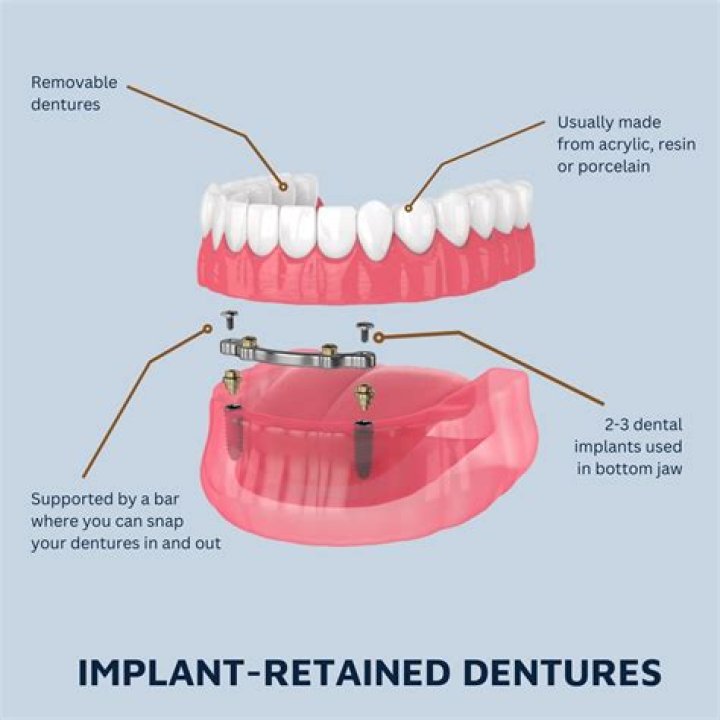 Do permanent dentures stop bone loss?