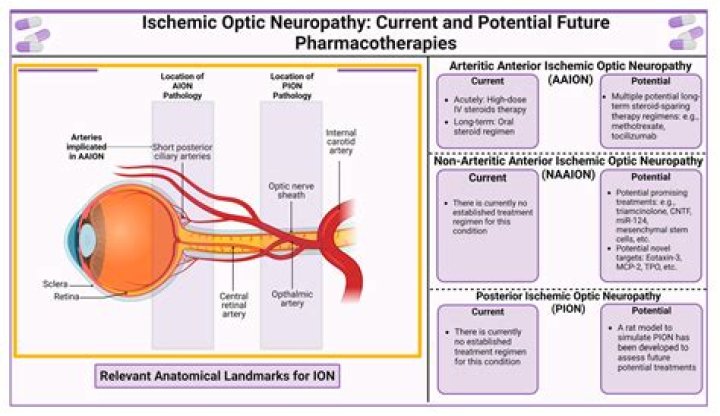 Do steroids help optic neuritis?