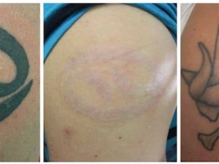Do tattoos scar?