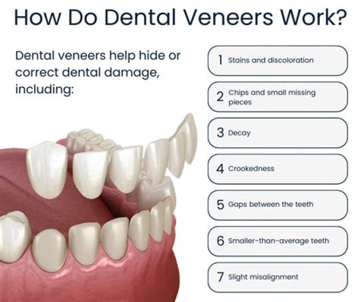 Do veneers get dirty?