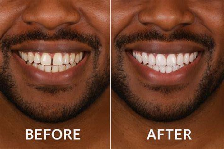 Do veneers stain like normal teeth?