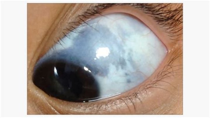 Do white eyes exist?