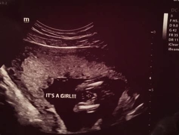 Does 3 lines on ultrasound mean girl?