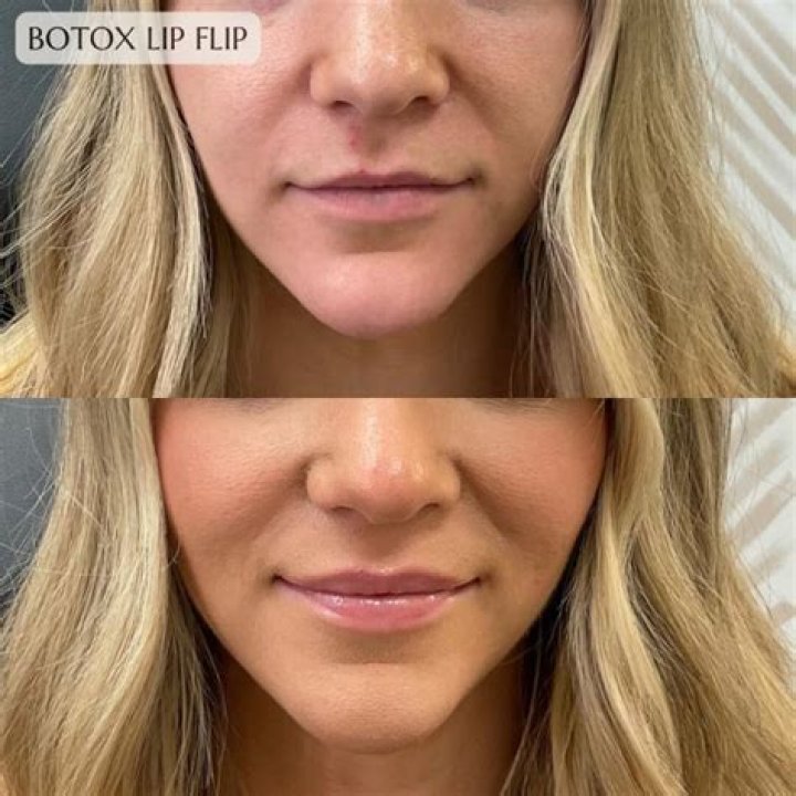 Does a lip lift make you look younger?