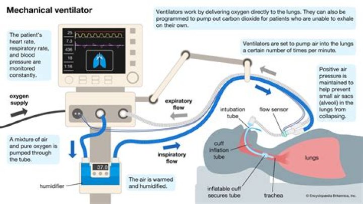 Does a ventilator cause brain damage?
