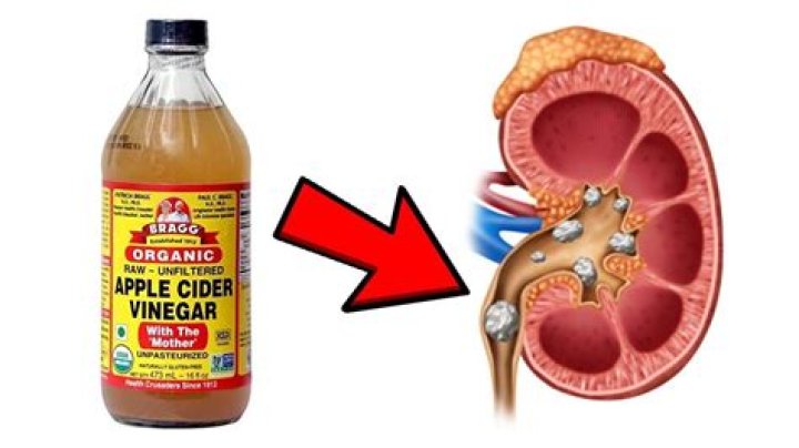 Does apple cider vinegar help with pancreatitis?