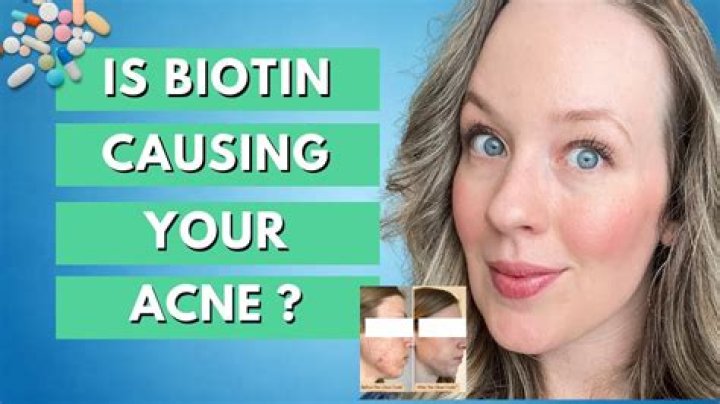 Does biotin cause pimples?