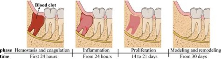 Does blood clot turn white after tooth extraction?