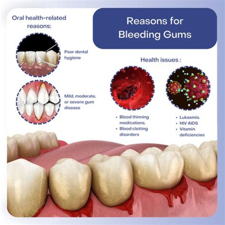 Does brushing your teeth get rid of tonsil stones?