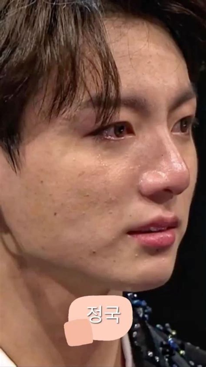 Does BTS have acne?