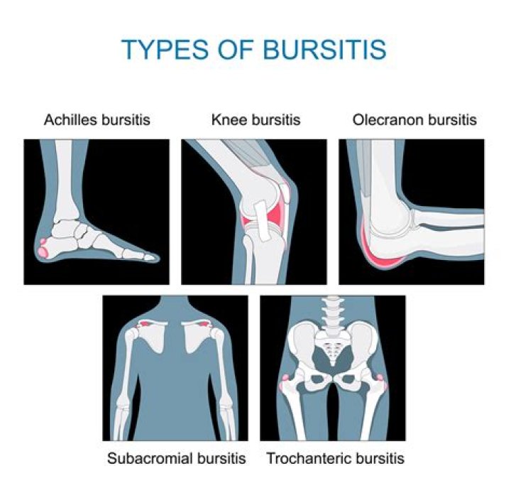 Does bursitis spread to other joints?
