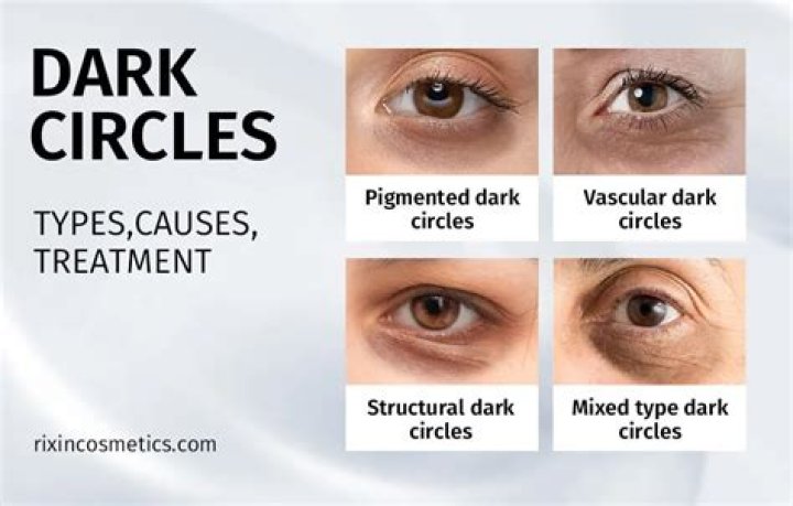 Does computer cause dark circles?