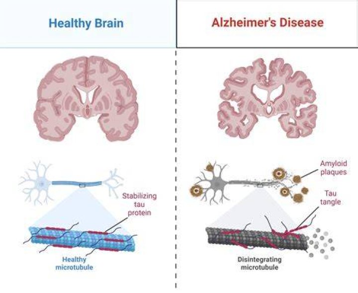 Does cooking in aluminum cause Alzheimer's?