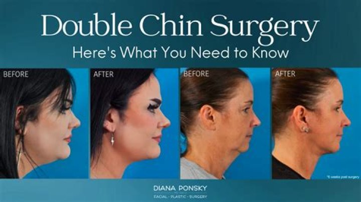 Does everyone have double chin?