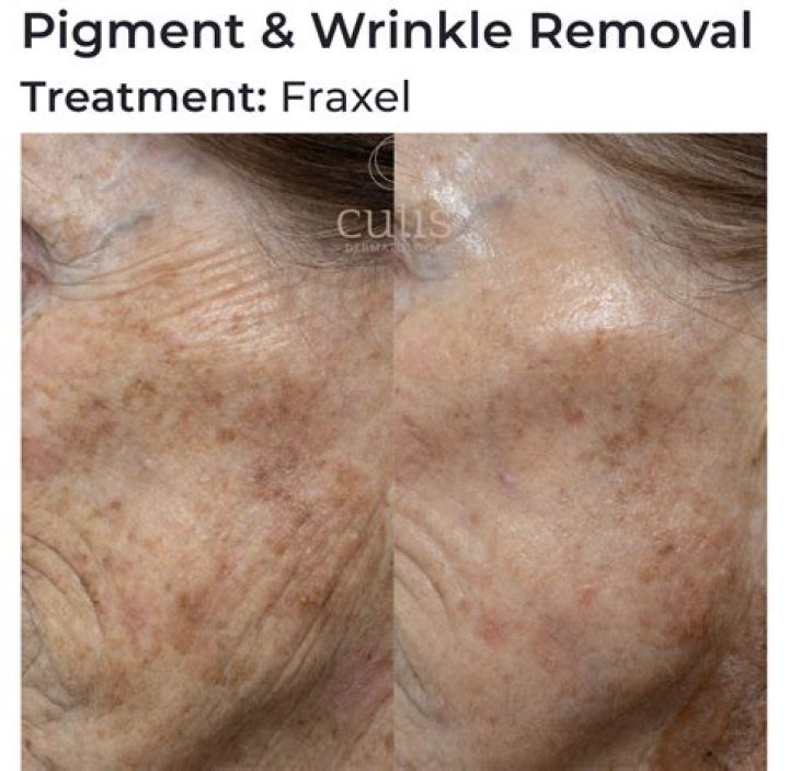 Does Fraxel laser get rid of wrinkles?