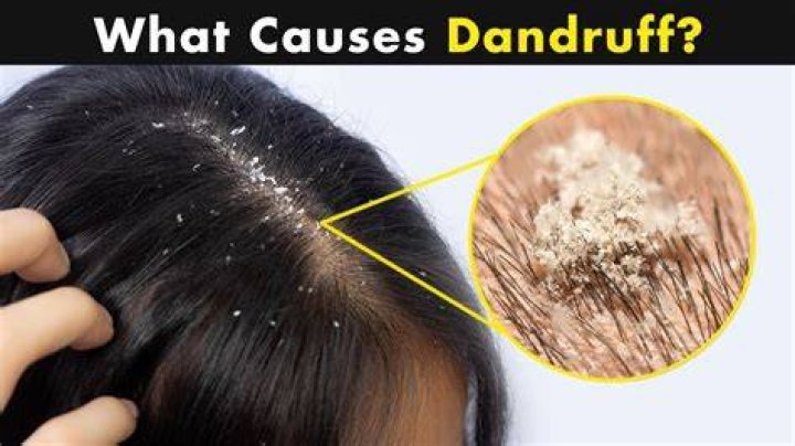 Does hot water increase dandruff?
