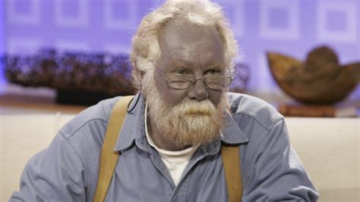 Does inbreeding cause blue skin?