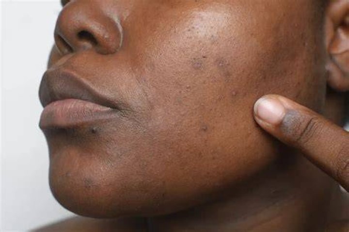 Does liver problems cause dark spots on face?