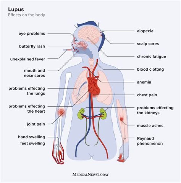 Does lupus make you feel exhausted?
